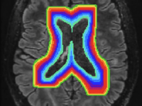 Spatial Distribution of Lesion Expansion in&nbsp;MS